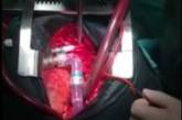 В Украине впервые пересадили механическое сердце