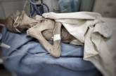 В больнице Днепра умерла женщина, доведенная до истощения