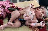 В Индии родилась девочка с четырьмя ногами и тремя руками. ФОТО