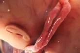 В Китае родился живым ребенок, у которого шея была обвита пуповиной 6 раз