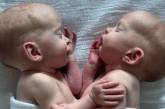 Сіамських близнючок роз'єднали під час ризикованої 4-годинної операції (ФОТО)
