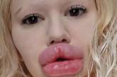 Жінка з найбільшими губами у світі показала, який мала вигляд до екстремального перевтілення