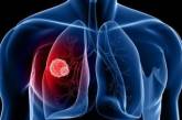 Курящим на заметку: медики назвали ранние симптомы рака легких
