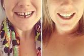 Ощутимая разница: как брекеты меняют улыбку. Фото