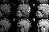 Ученые научились заменять поврежденные клетки мозга