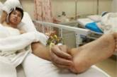 В Китае хирурги пришили мужчине кисть к ноге 