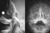 Австралийский ученый попал в больницу с магнитами в носу, пытаясь создать устройство от коронавируса. ФОТО