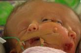 Австралийка родила девочку с двумя лицами и мозгами 