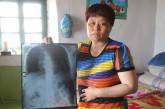 Китаянка прожила 10 лет с иглами в почке, легком и под сердцем  