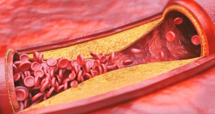 Високий холестерин: кому загрожує та як його знизити Високий холестерин: кому загрожує та як його знизити