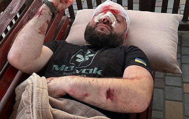 В Затоке местный житель избил ветерана АТО за просьбу выключить русскую музыку В Затоке местный житель избил ветерана АТО за просьбу выключить русскую музыку