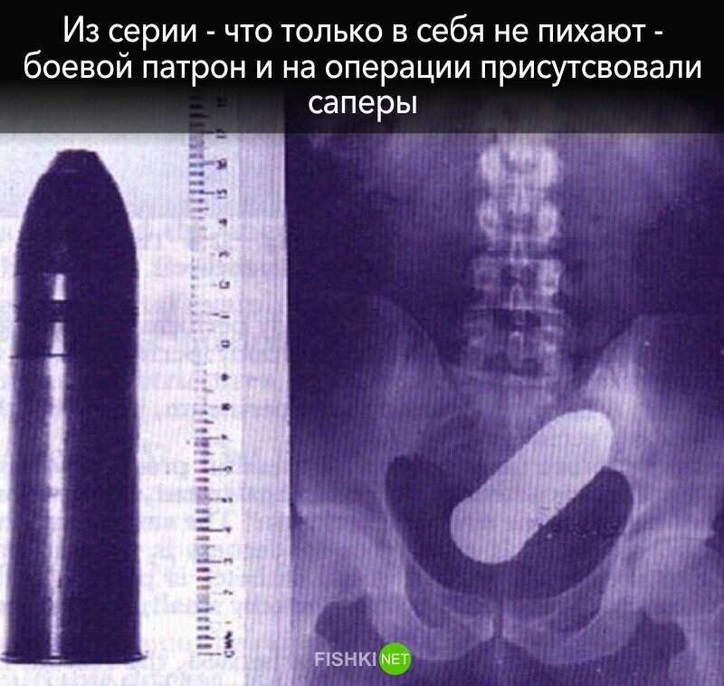  20 случаев из жизни рентгена, который видел некоторый ужас (23 фото) 
