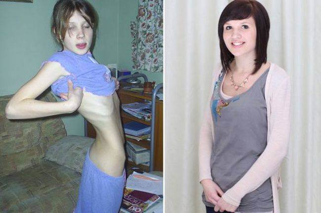 Борьба с аннорексией: фото до и после