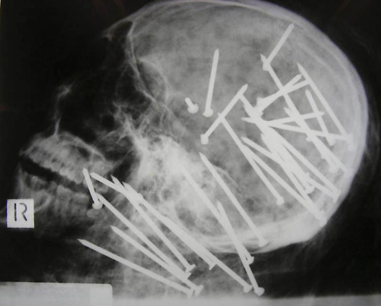 Самые необычные случаи за время существования рентгена. ФОТО