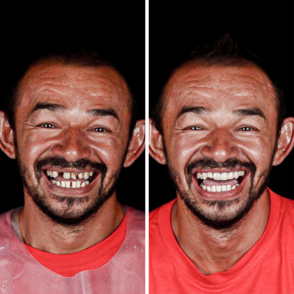 Бразильский дантист-альтруист ездит по всему миру, чтобы дарить людям новые улыбки - бесплатно!