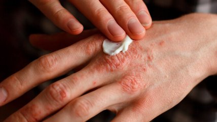 Поліпшити стан шкіри допоможуть дієта, вітаміни та алое