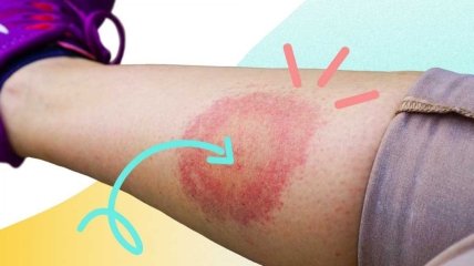 Так виглядає місце укусу кліща під час хвороби Лайма