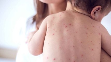 Це захворювання може бути особливо небезпечним для дітей та вагітних жінок.