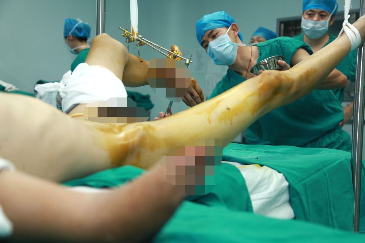Чоловіку пришили відрізану руку до ноги / Фото: Hap/Quirky China News/REX/Shutterstock / © 