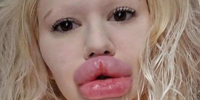 Жінка з найбільшими губами у світі показала, який мала вигляд до екстремального перевтілення