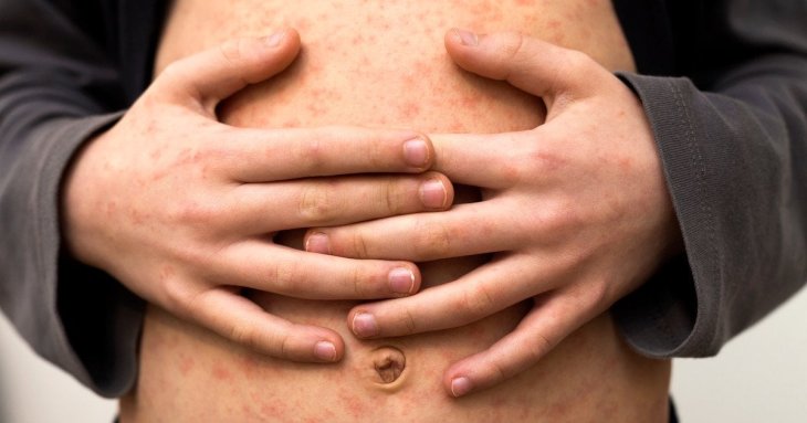 Що таке кір та чому він такий заразний і небезпечний