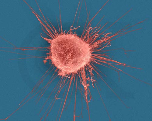 Ученые узнали секрет распространения рака в организме 
