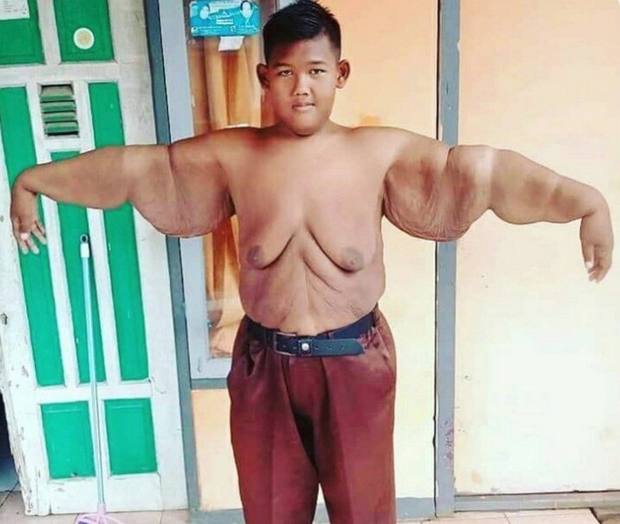 Самый толстый мальчик в мире весил больше 190 кг в 10 лет. За 3 года он смог похудеть больше чем в 2 раза. ФОТО