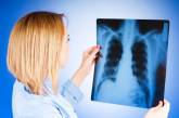 Николаевщина находится на 13 месте по заболеваемости туберкулезом в Украине