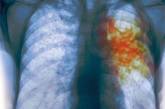 Одессе грозит эпидемия туберкулеза?