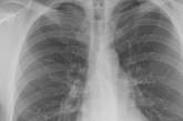 В Украине ежегодно от туберкулеза умирает 4 тысячи человек