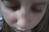 Школьники в Керчи избили новенькую: девочке сломали нос
