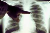 На Николаевщине количество умерших от пневмонии не превышает обычные показатели, - УОЗ ОГА