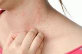 Дерматологи предупредили о симптоме коронавируса, который проявляется на коже