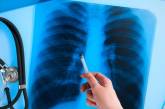 В Украине за месяц обнаружили более 1,2 тысячи случаев туберкулеза