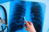 В Украине обновили стандарты медицинской помощи больным туберкулезом