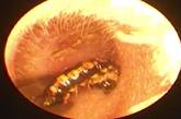 Врачи обнаружили в ухе пациента червя 