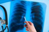 В Николаевской области за год туберкулезом заболели 11 детей