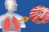 У ЦОЗ розповіли, які категорії людей належать до груп ризику в розвитку туберкульозу