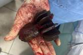 Військові медики витягли з тіла бійця ЗСУ хвостовик міни (фото)