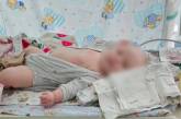 Из-за обстрела врага жительница Николаевщины осталась без ноги, у ее двухмесячной малышки травмы