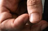 Медики объяснили, почему возникают заусенцы на пальцах и как от них избавиться