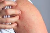 Названі симптоми псоріазу та способи боротьби зі шкірним захворюванням