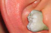 Британец прожил 30 лет с зубом в ухе