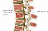 Остеопороз – это естественный этап старения человека или его можно устранить: мифы и правда
