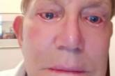 Пенсіонер чотири роки не міг заплющити очі після невдалої пластичної операції – фото