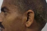 Чоловіку, який жив із "двома головами" 15 років, видалили величезну пухлину – фото до і після