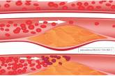 Ученые разработали новый подход к лечению атеросклероза