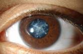 Возможные причины и первые симптомы катаракты