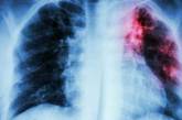 Обнаружено соединение, которое поможет бороться с туберкулезом