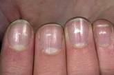 Эксперт рассказал, как распознать болезни по состоянию ногтей